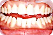 予防歯科：症例1