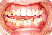 予防歯科：症例1