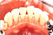 予防歯科：症例2