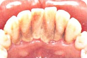 予防歯科：症例2