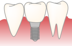 インプラント