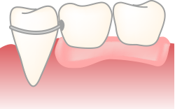 部分入れ歯