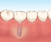 インプラント