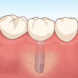 インプラント